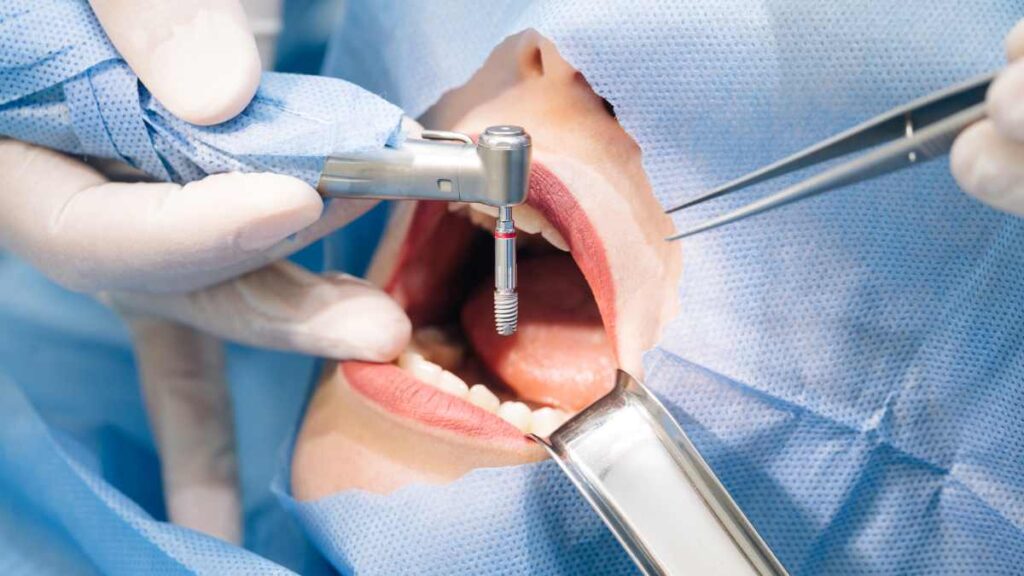 Quanto tempo para fazer um implante dentario