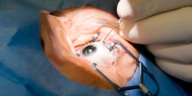 Qual é o preço da cirurgia de catarata com lente multifocal